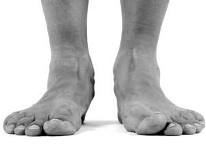 Flat Feet problems can be treated on the Sunshine Coast.