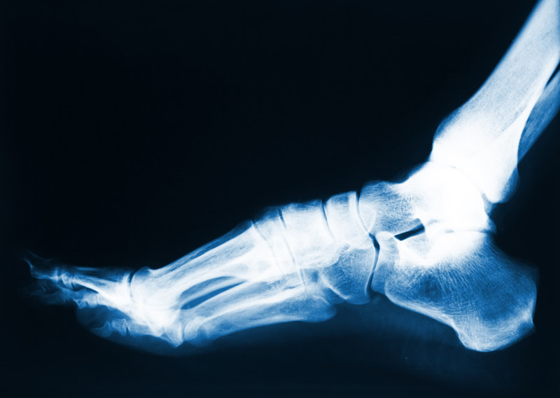arthritis