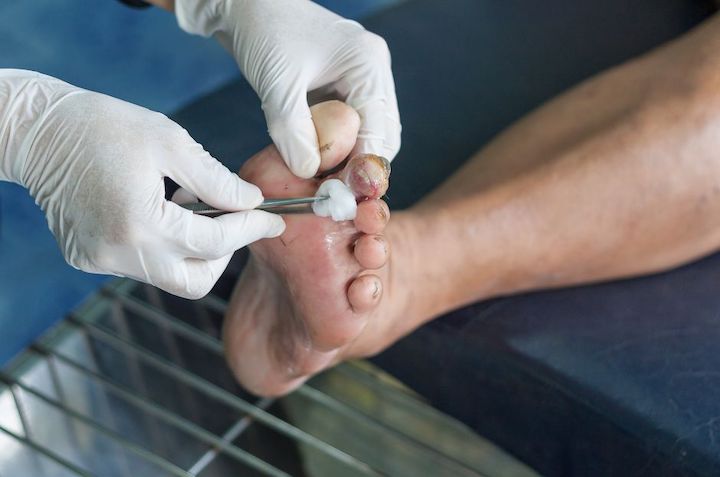 Why foot hygiene is important